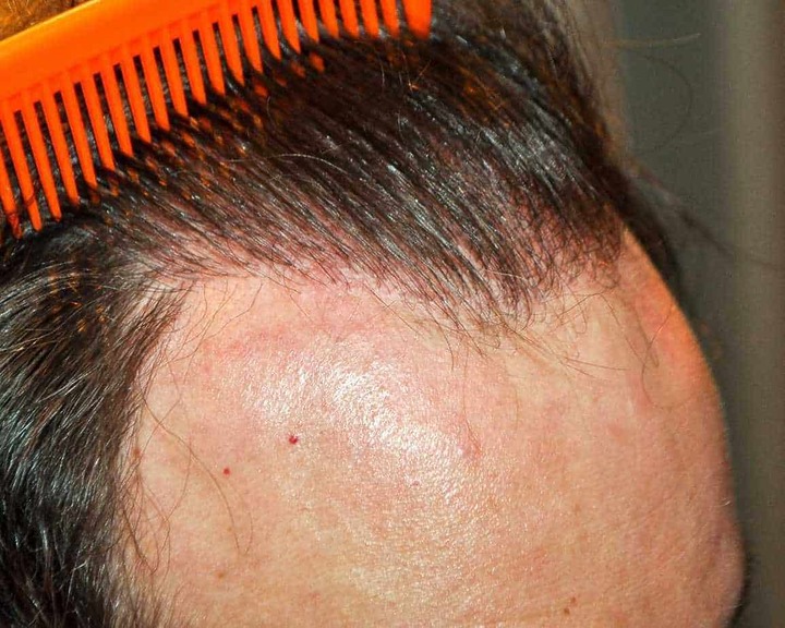 2000 Graft Hair Transplant Coverage, Results, Costs