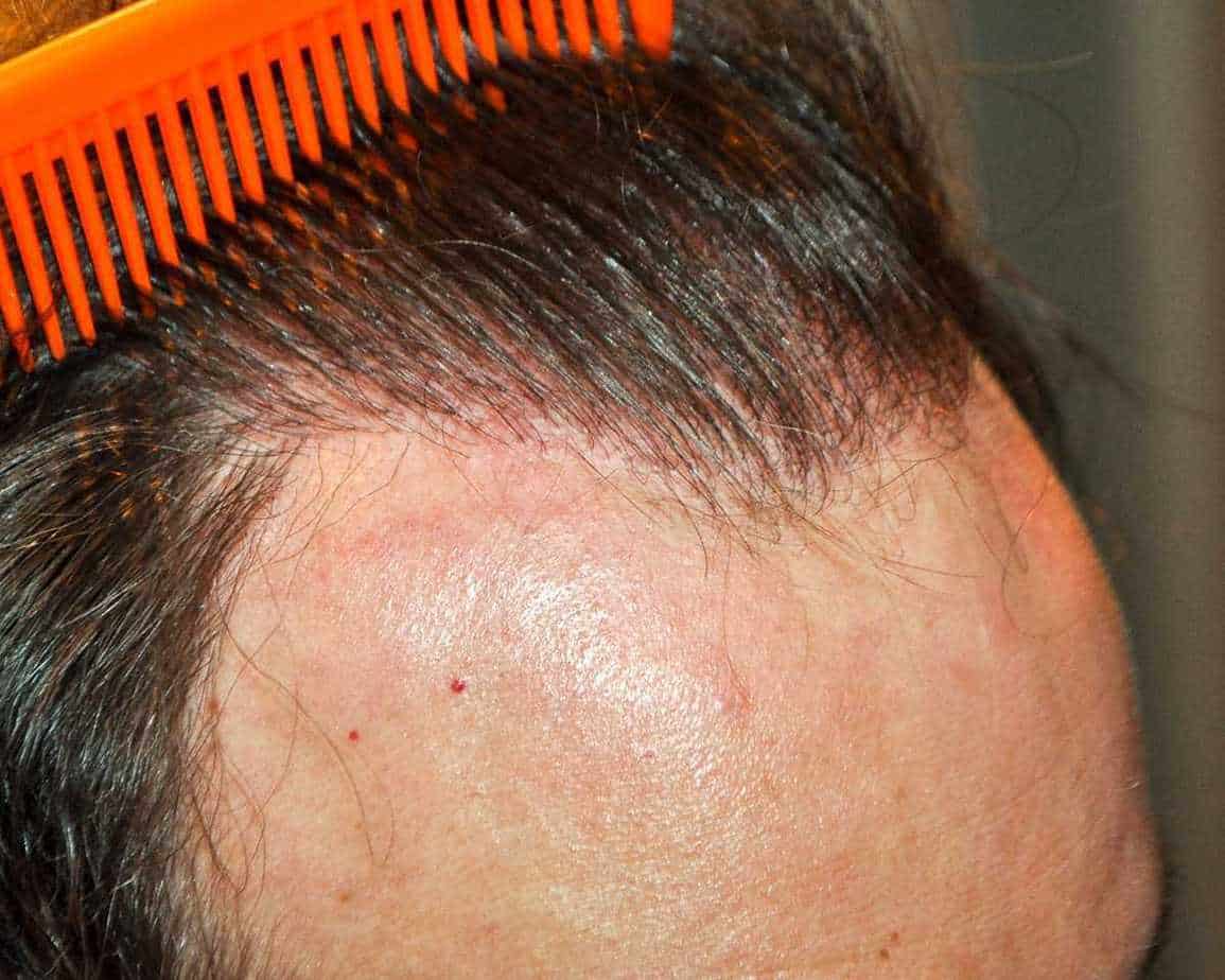 2000 Graft Hair Transplant: Coverage, Results, Costs