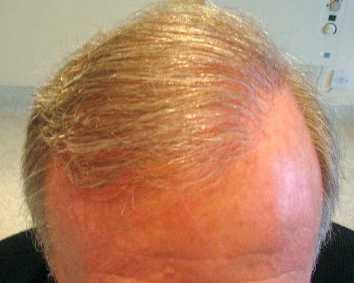3000 Graft Hair Transplant: Coverage, Results, Costs, Wimpole Clinic
