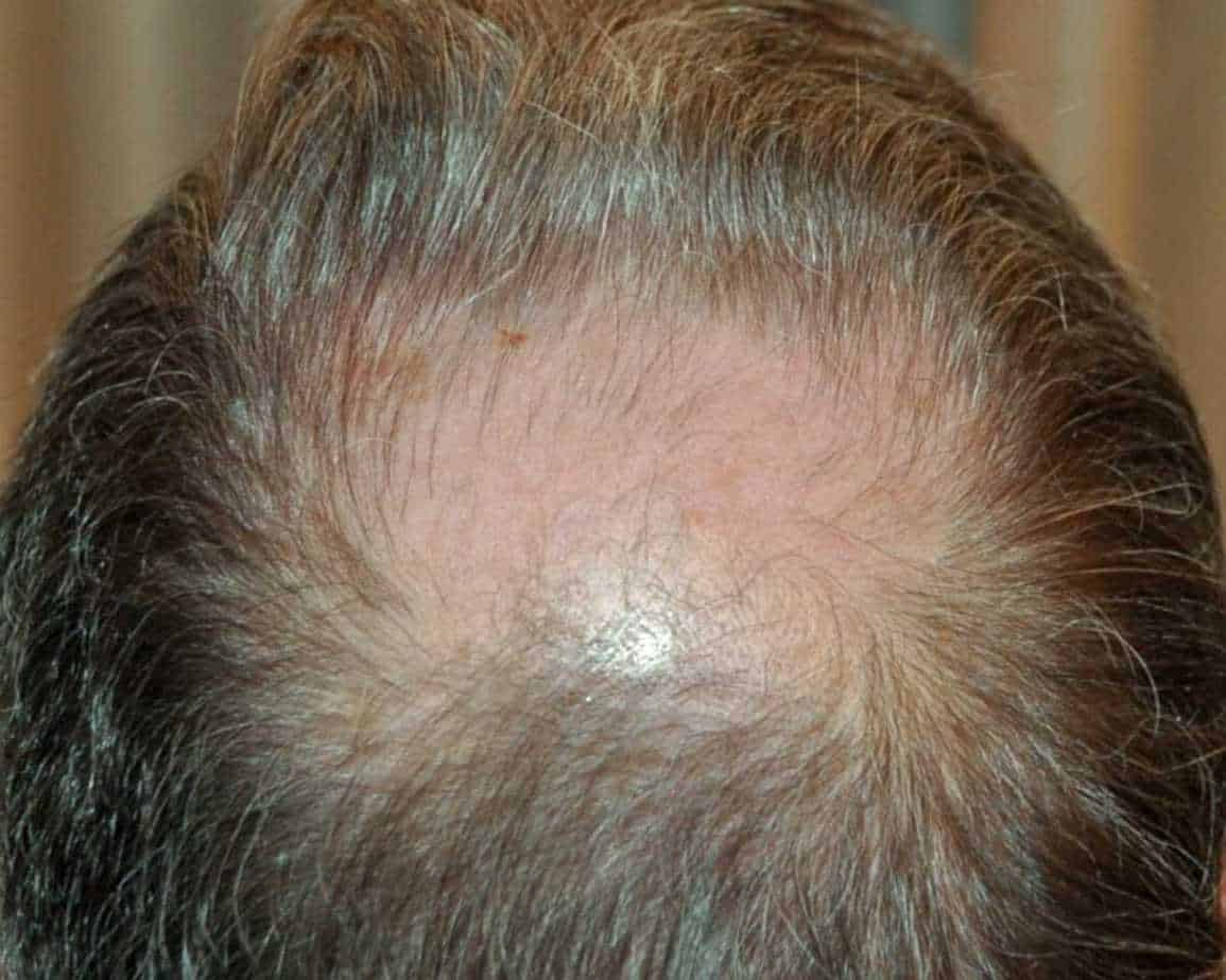 Bald Spot On Crown: How To Spot It & How To Stop It