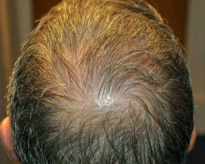 How Much Does A Crown Hair Transplant Cost?