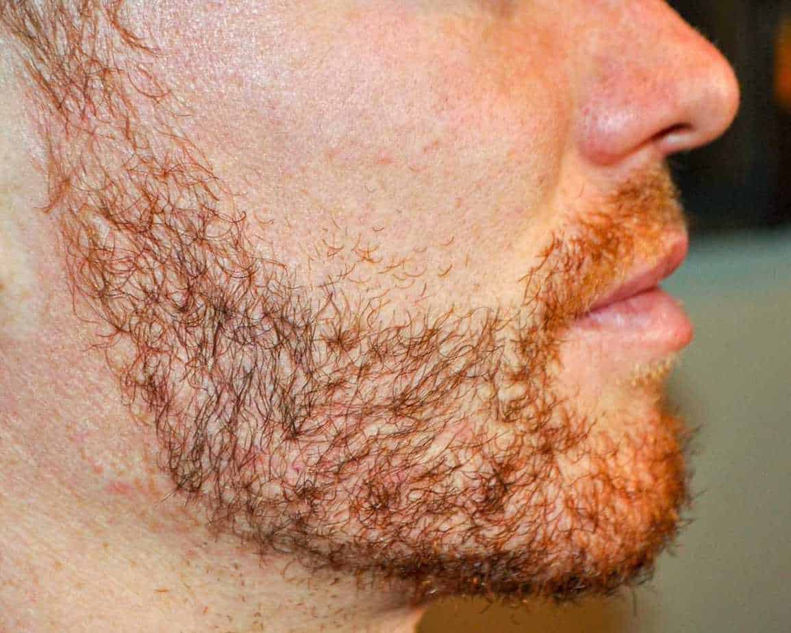 beard implants after