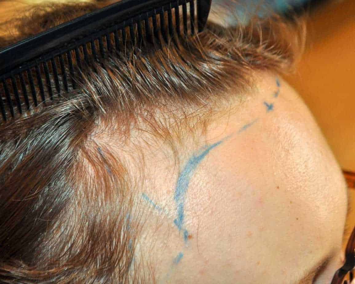 Frontal Balding: Causes, Symptoms, Treatments, Wimpole Clinic