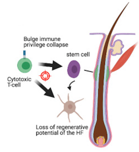 Informational graphic showing how immune cells infiltrate and damage hair follicle bulges