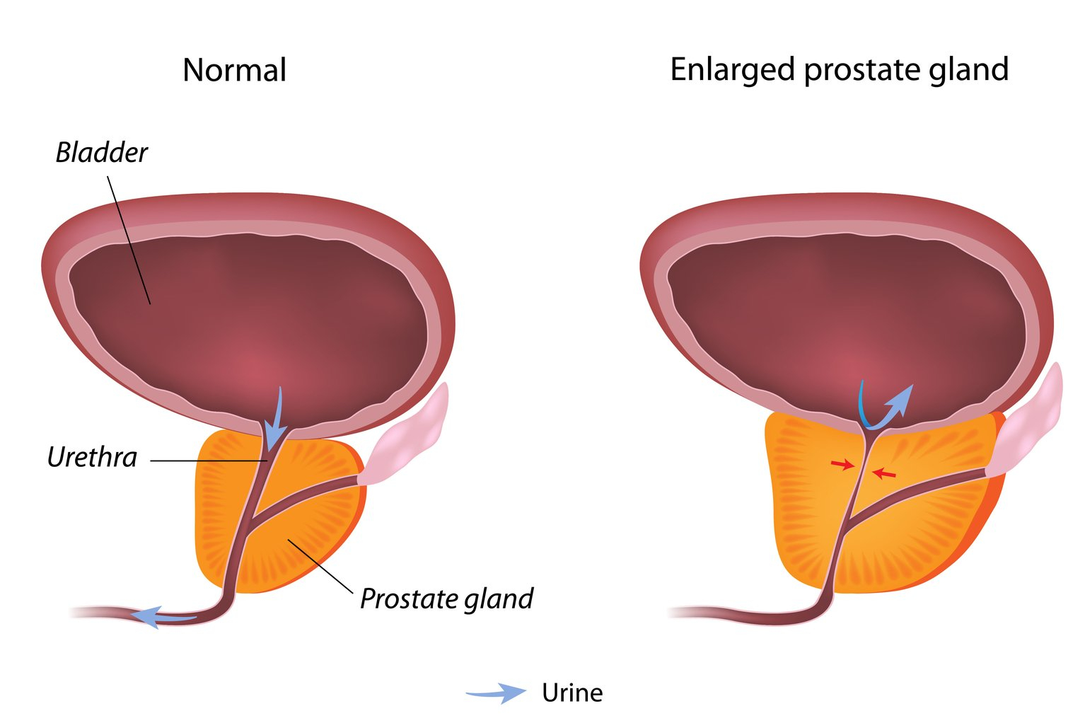 Informational graphic comparing and contrasting a normal prostate gland vs an enlarged prostate gland