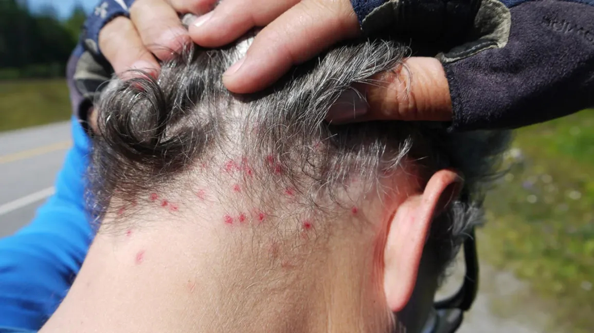 Insect bites on neck and scalp