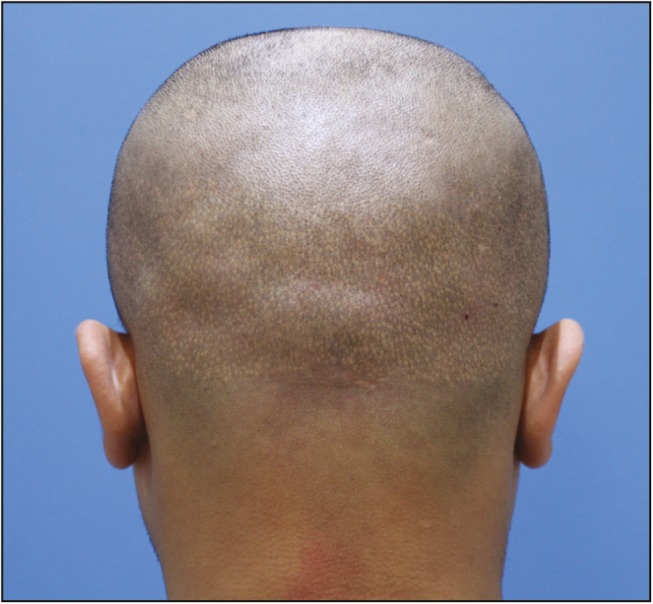fue scars after hair transplant