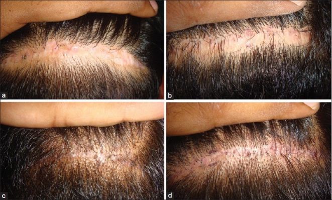 FUT strip harvest wound scars after 4 types of closure have been applied