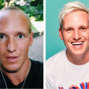 Jamie Laing Hair Transplant: Everything You Need To Know