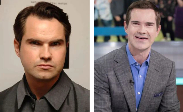 Jimmy Carr before and after hair transplant
