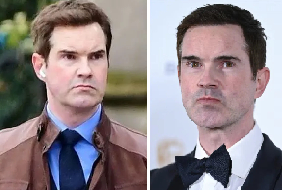 Jimmy Carr's significant hair growth in his hairline following his hair transplant