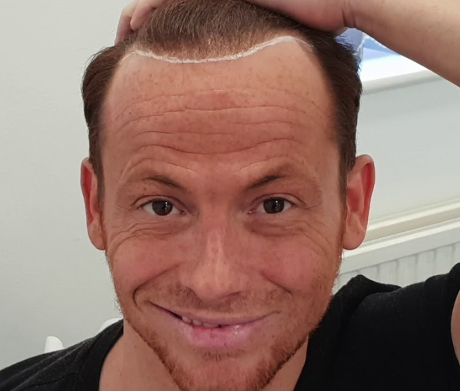 Joe Swash ready for his third hair transplant procedure