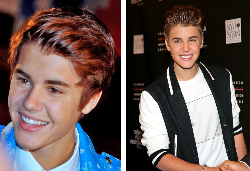 Justin Bieber Hair Loss: Everything You Need To Know, Wimpole Clinic