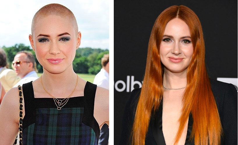 29 Bold Bald Women Who Rocked A Shaved Head, Wimpole Clinic