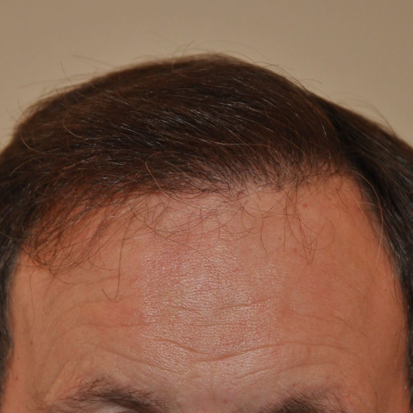 1000 Graft Hair Transplant Coverage, Costs, Results