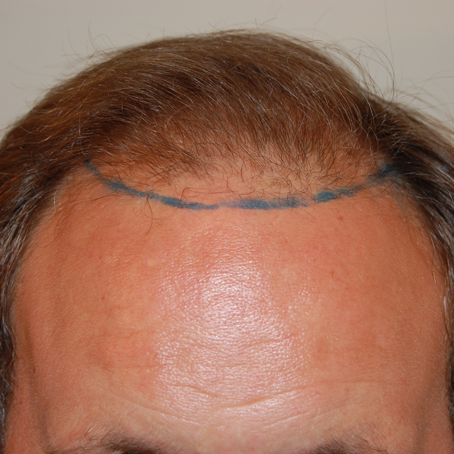 1000 Graft Hair Transplant: Coverage, Costs, Results, Wimpole Clinic