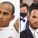 Lewis Hamilton Hair Transplant: Everything You Need To Know