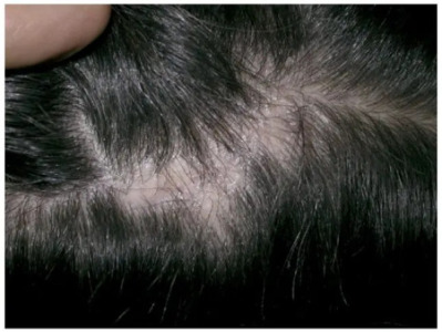 Lichen planopilaris (LP) on the scalp