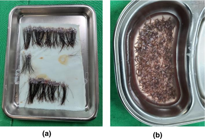 Long hair transplant grafts after trimming (left) vs traditionally shaved hair transplant grafts