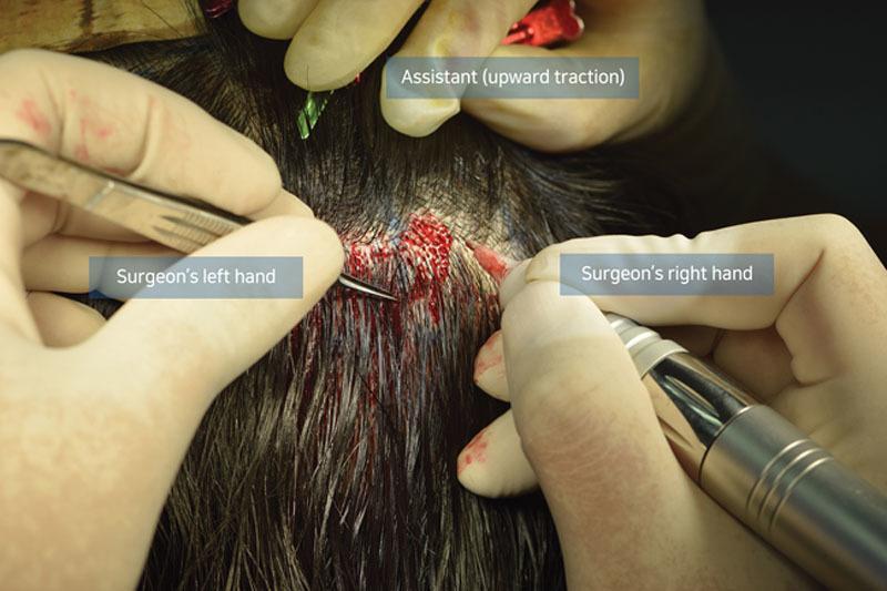 surgeons in the middle of UFUE hair transplant surgery