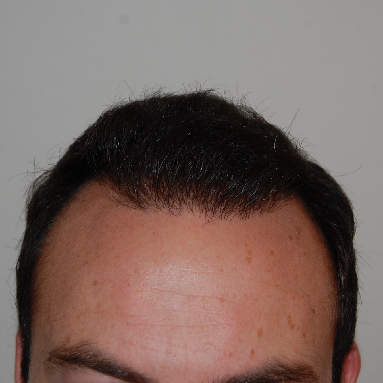 Hair Transplant Close Up: Photos, Videos &#038; Results, Wimpole Clinic