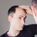 Can Your Hair Grow Back After Balding Naturally?