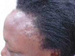 Marginal scarring in long standing traction alopecia