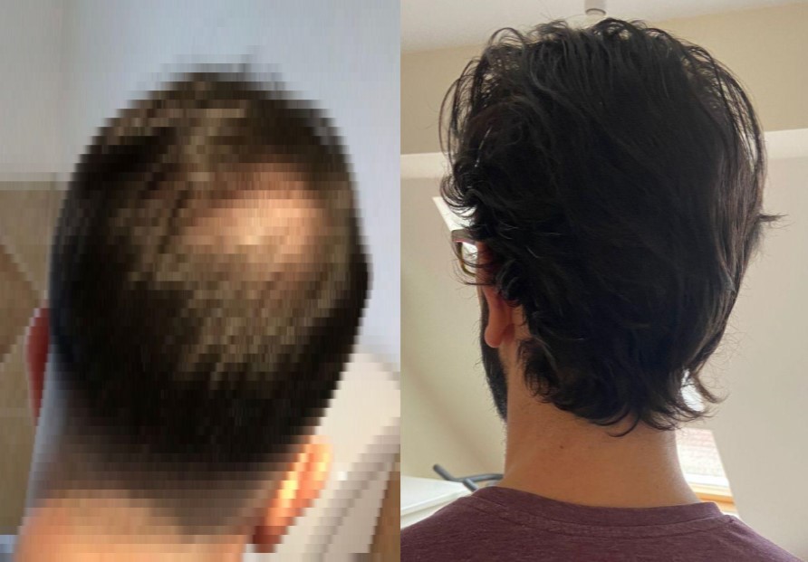 Crown Hair Transplant, Wimpole Clinic