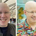 Matt Lucas Alopecia: Everything You Need To Know