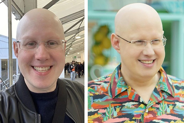 Matt Lucas Alopecia: Everything You Need To Know