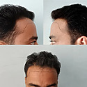 How To Fix A Messed Up Hairline