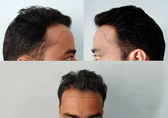 bad hairline featured image