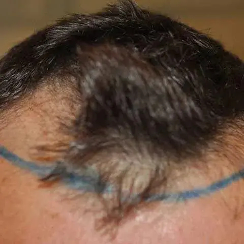 Receding hairline example 1