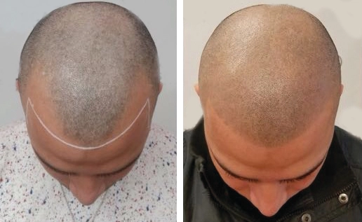 before and after scalp micropigmentation to fix a bad hairline