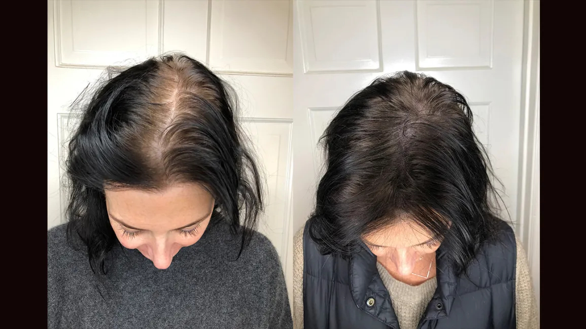 before and after scalp micropigmentation for hair thinning