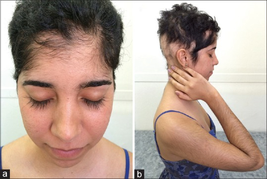 Hypertrichosis in a female hair loss patient.