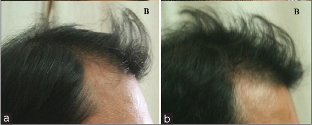 Before and after use of Minoxidil 5% solution twice daily for 4 months.