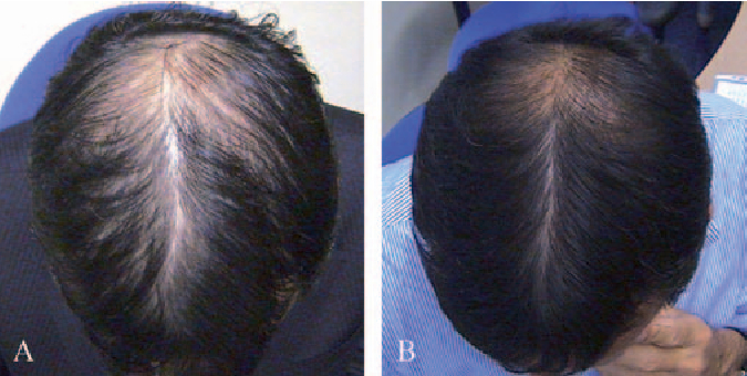 Male patient photos at baseline and after six months of Carexidil use