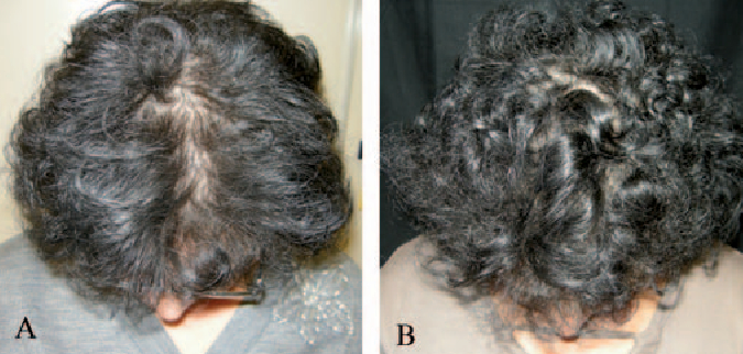 Female patient photos at baseline and after six months of Carexidil use