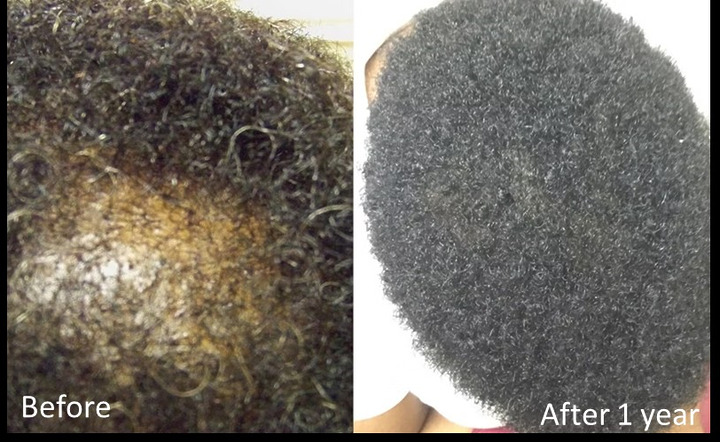 minoxidil results after 1 year female forum
