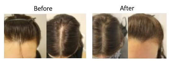 Minoxidil before and after in female patient
