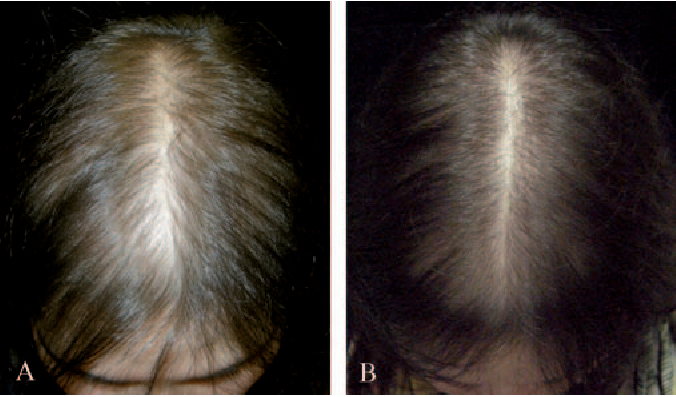 before and after results of using 5% liquid Minoxidil on a female patient