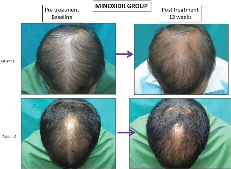 Before and after example of patients who used topical Minoxidil for 12 weeks