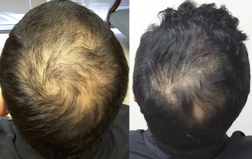 Minoxidil results after 12 months