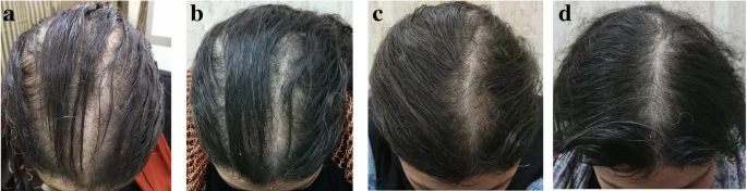 The effects of 2% Minoxidil use after 6 months