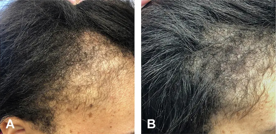 Minoxidil for traction alopecia