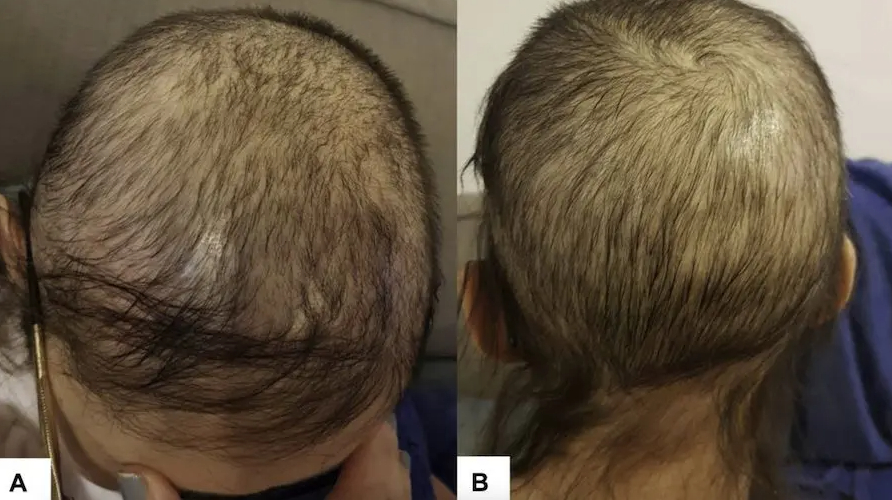 Minoxidil for treatment of chemotherapy-related hair loss