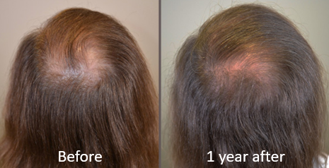 Minoxidil for treatment of telogen effluvium hair loss