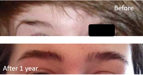 Before and after results of taking Minoxidil for eyebrow hair loss