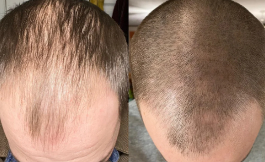Before and after taking 1.25mg of oral Minoxidil for chronic telogen effluvium